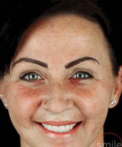 patient kassandra showing her porcelain veneers